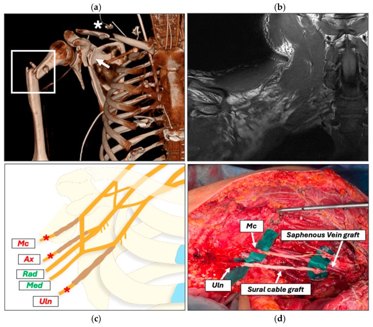 Floating shoulder with brachial plexus injury: 3D CT of the shoulder girdle, an MRI, a labelled diagram of the plexus terminal nerves and an operative photograph of nerve and vein grafts