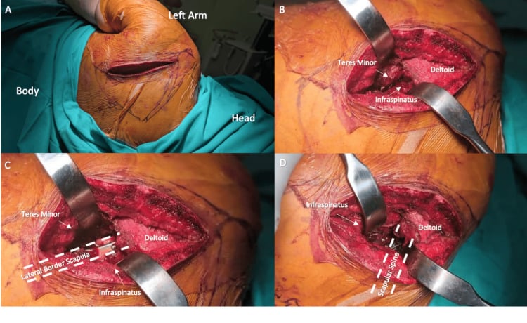 Modified direct lateral approach to a left scapula, with teres minor, infraspinatus, deltoid, the lateral border of the scapula and the scapular spine labelled