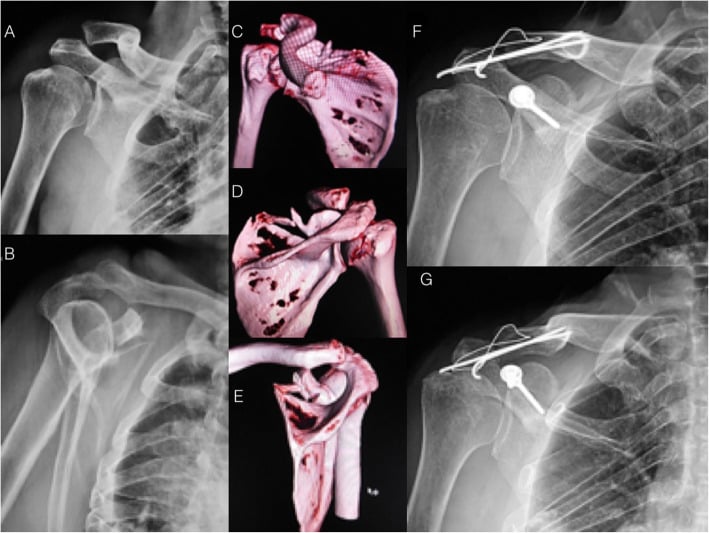 Preoperative radiographs and 3D CT of combined coracoid-base, scapular-spine and AC-joint injuries, and postoperative radiographs after fixation with a coracoid screw and wires along the lateral clavicle and acromion