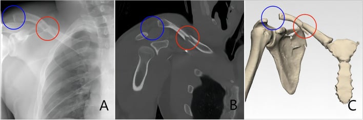 AP radiograph, CT and 3D reconstruction of a clavicle fracture with AC-joint injury, the fracture circled in red and the AC joint in blue