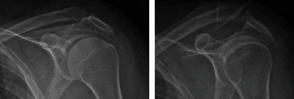 Two shoulder radiographs from a case of concomitant acromion and distal-clavicle fractures