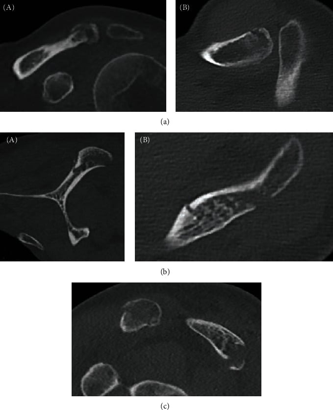 Three sets of CT images, labelled a to c, from the same case of concomitant distal-clavicle and acromion fractures