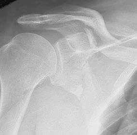 AP shoulder radiograph showing floating shoulder with clavicle and scapula fractures