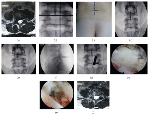 Multi-panel figure of a fluoroscopically guided spinal procedure with pre-operative MRI, intraoperative AP and lateral fluoroscopic images, endoscopic views and a post-procedure CT