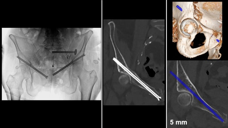AP fluoroscopy, postoperative CT and CT-based corridor planning for superior pubic ramus screw fixation.