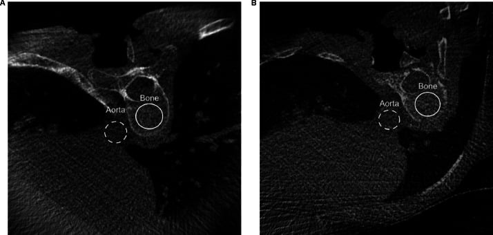 Matched axial intraoperative 3D fluoroscopy images acquired with standard-dose and low-dose protocols.