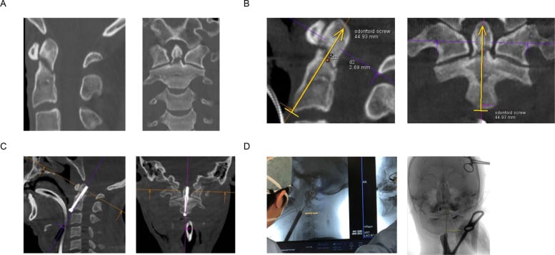Four-panel workflow showing preoperative cone-beam CT, trajectory planning, post-procedure CT and live fluoroscopic overlay.