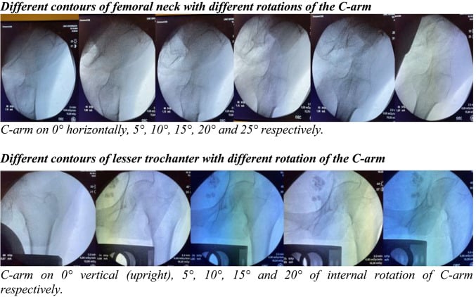 Serial fluoroscopic views showing how femoral-neck and lesser-trochanter contours change with C-arm rotation.