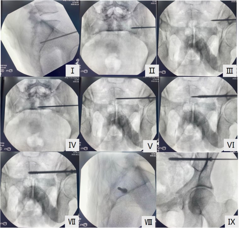 Sequential pelvic lateral, inlet, outlet and AP fluoroscopic views used for guidewire placement and cannulated screw insertion.