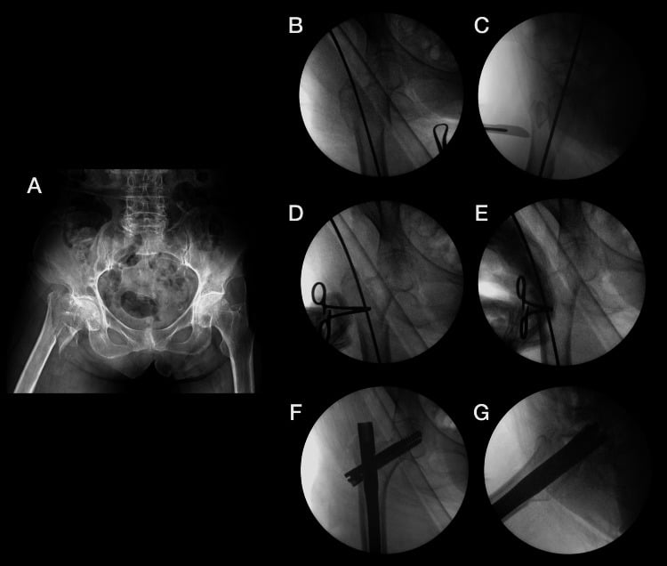 Sequential radiograph and intraoperative fluoroscopic views for reduction and cephalomedullary fixation of an unstable intertrochanteric fracture.