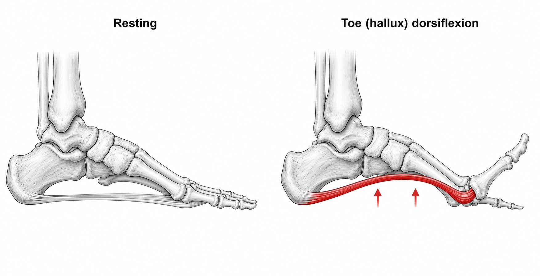 Two-panel diagram of the windlass mechanism: resting foot versus hallux dorsiflexion tightening the plantar fascia and raising the arch