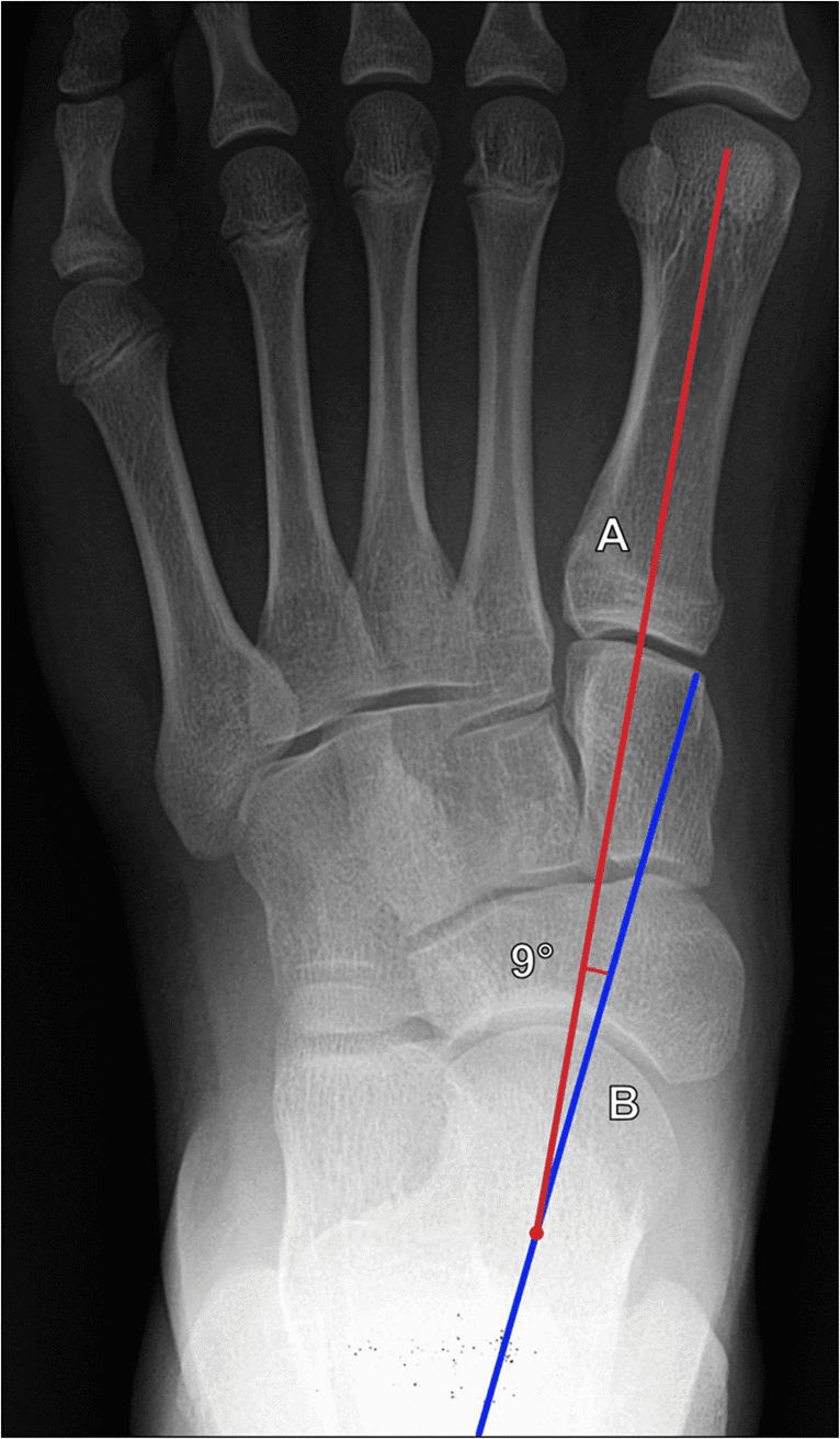 Weight-bearing dorsoplantar radiograph measuring the AP talo–first-metatarsal angle
