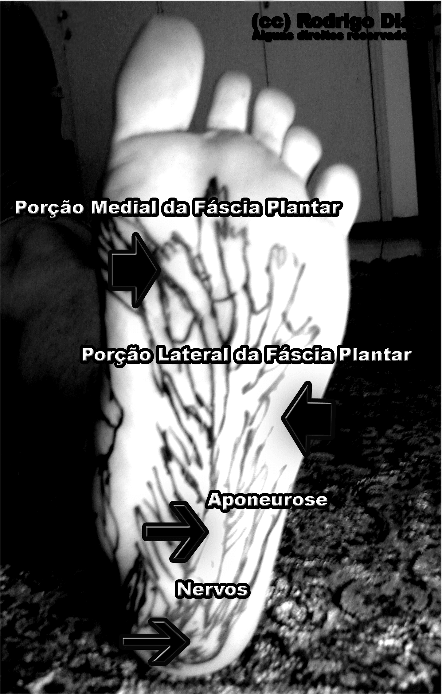 Plantar view of the plantar fascia spanning heel to toes