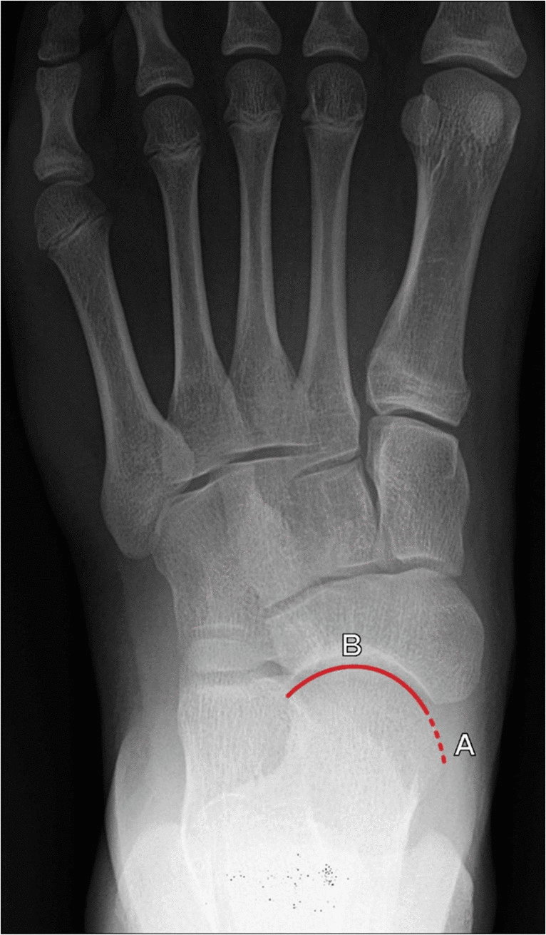 Dorsoplantar radiograph measuring talonavicular uncoverage