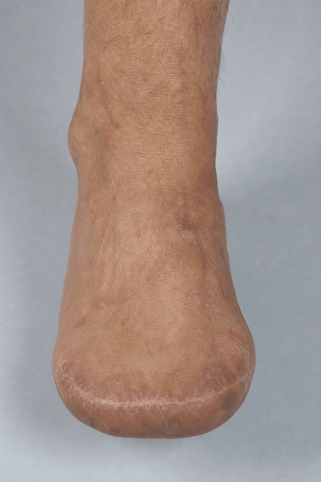 Clinical photograph of a healed transmetatarsal amputation stump of the foot.