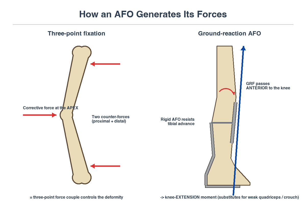 Diagram of AFO biomechanics: three-point fixation as a force couple, and a ground-reaction AFO holding the ground-reaction force anterior to the knee to create a knee-extension moment