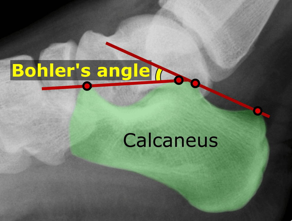 Lateral foot radiograph demonstrating Böhler's angle on the calcaneus