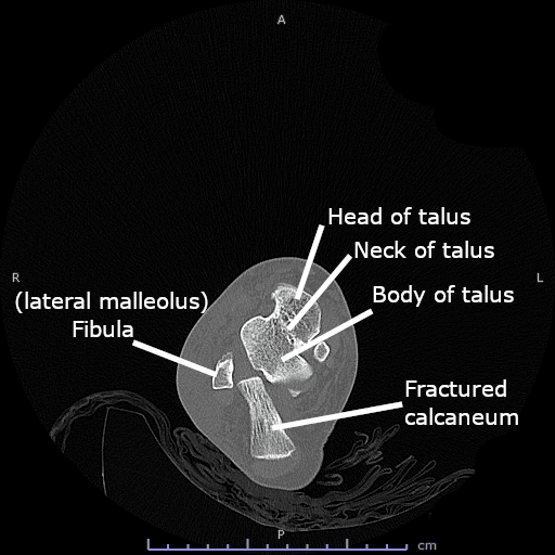 Axial CT of the hindfoot showing a fractured calcaneus