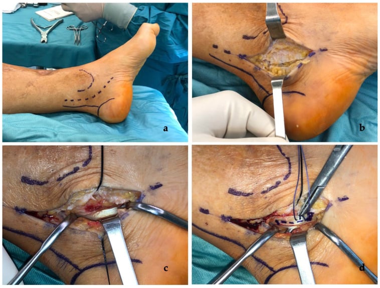 Operative sequence of retromalleolar flexor hallucis longus Z-plasty