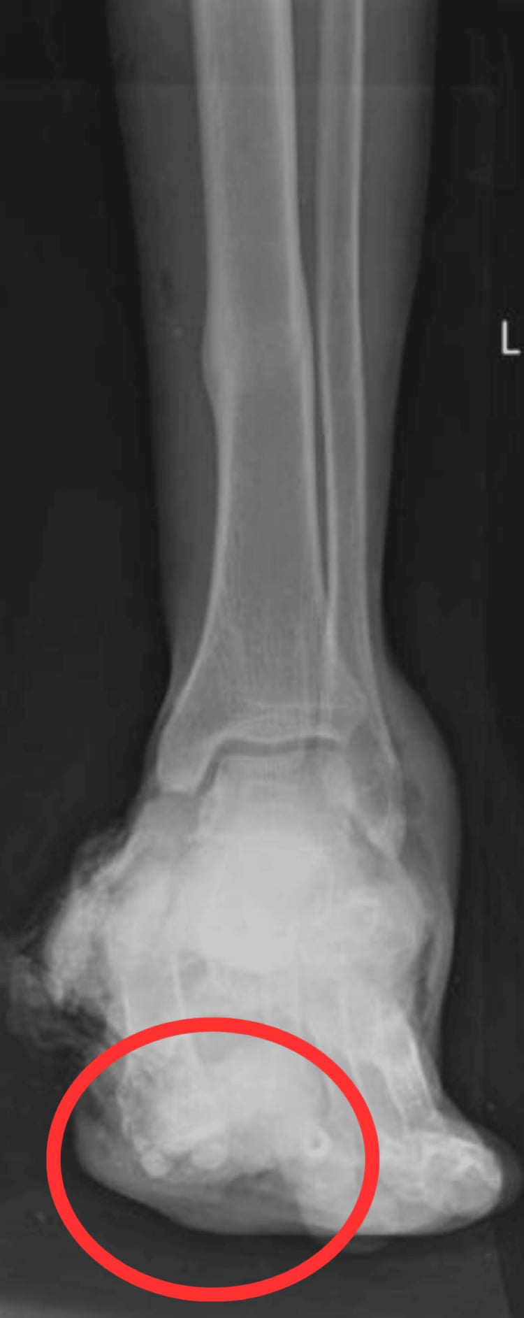 Radiograph of a crushed foot showing heel-pad avulsion