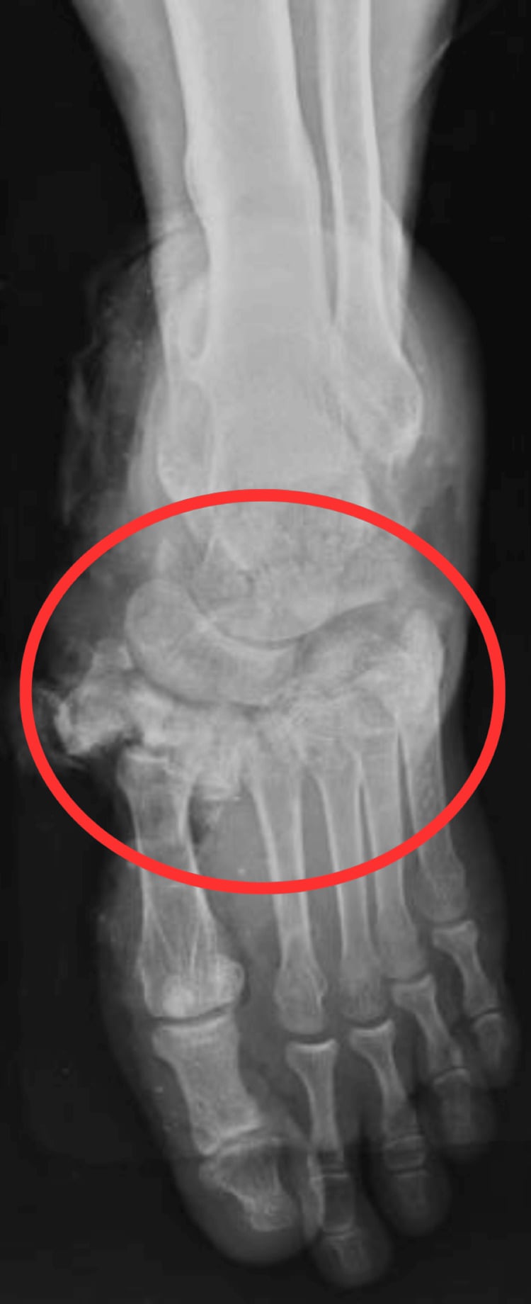 Anteroposterior radiograph of a crushed foot showing cuneiform and cuboid fractures