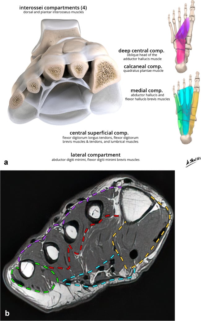 Illustrated coronal and plantar anatomy of the foot compartments paired with an axial T1 MRI