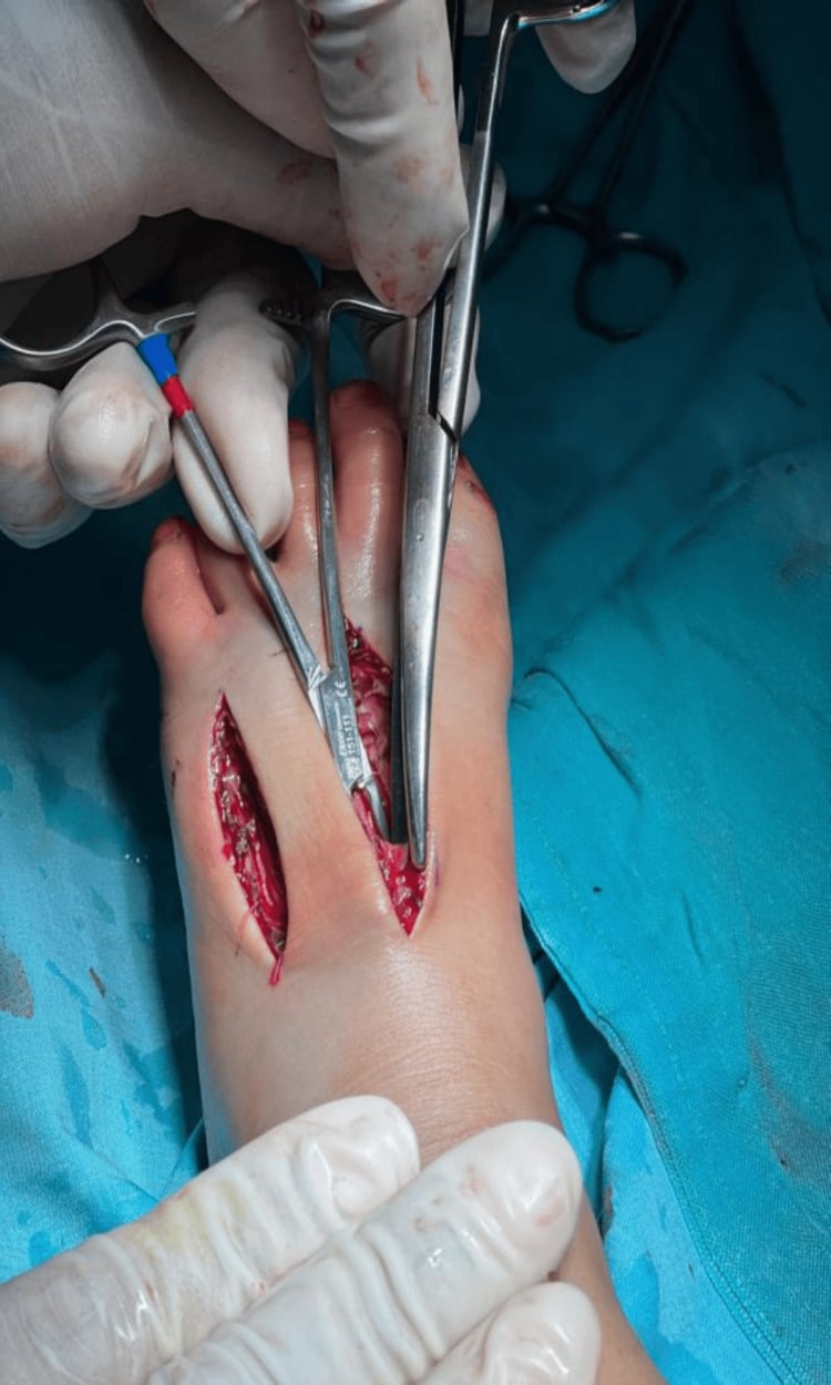 Intraoperative dorsal foot fasciotomy through two longitudinal incisions