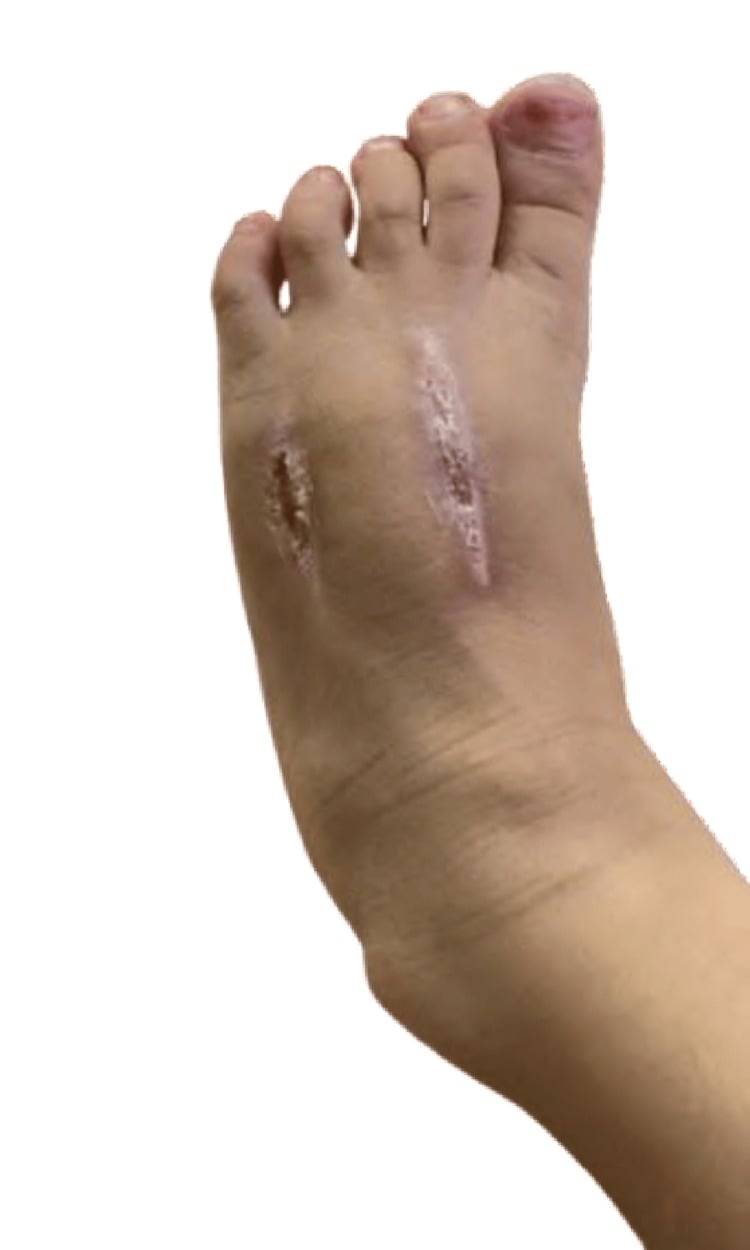 Healed dorsal foot fasciotomy wounds three weeks after decompression