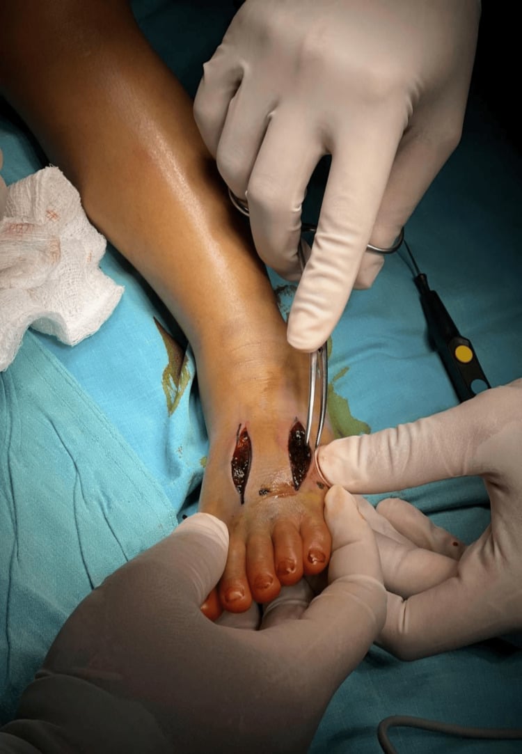 Intraoperative foot fasciotomy showing cyanotic muscle under tension
