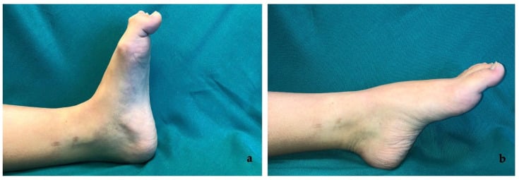 Dynamic clinical examination of a post-traumatic hallux checkrein deformity