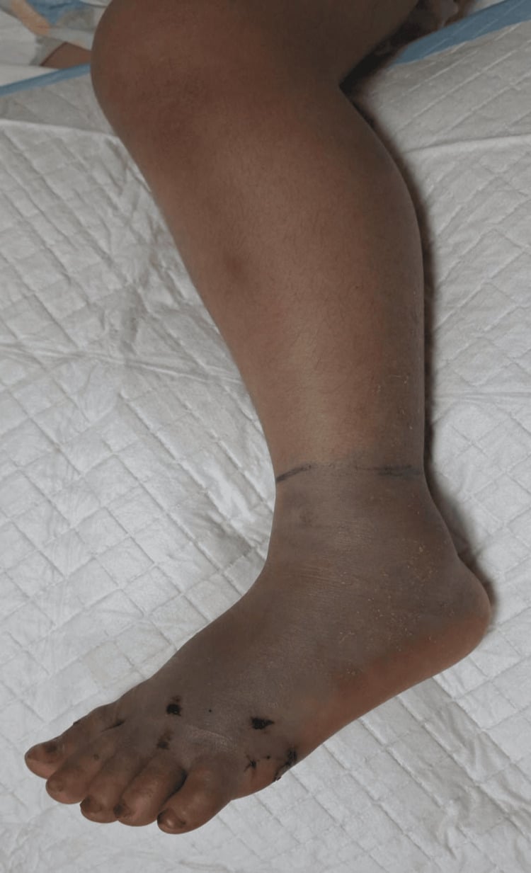 Clinical photograph of a markedly swollen discoloured foot before fasciotomy