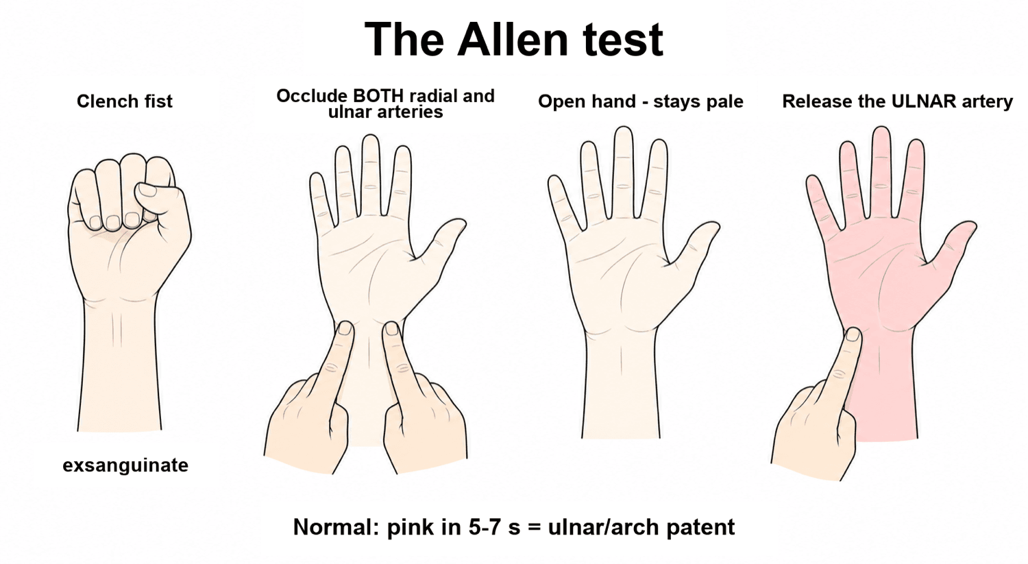 Four-step diagram of the Allen test: clench fist, occlude both wrist arteries, open the pale hand, release the ulnar artery and watch the hand flush pink.
