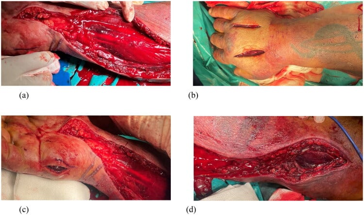 Four operative views of decompressive fasciotomy of the volar forearm, dorsal hand, hypothenar compartment and upper arm