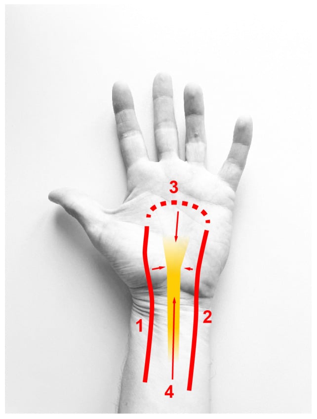 Schematic of radial, ulnar and recurrent arterial contributions to median nerve perfusion at the wrist