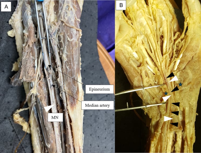 Cadaveric forearm dissections showing a persistent median artery travelling within and beside the median nerve
