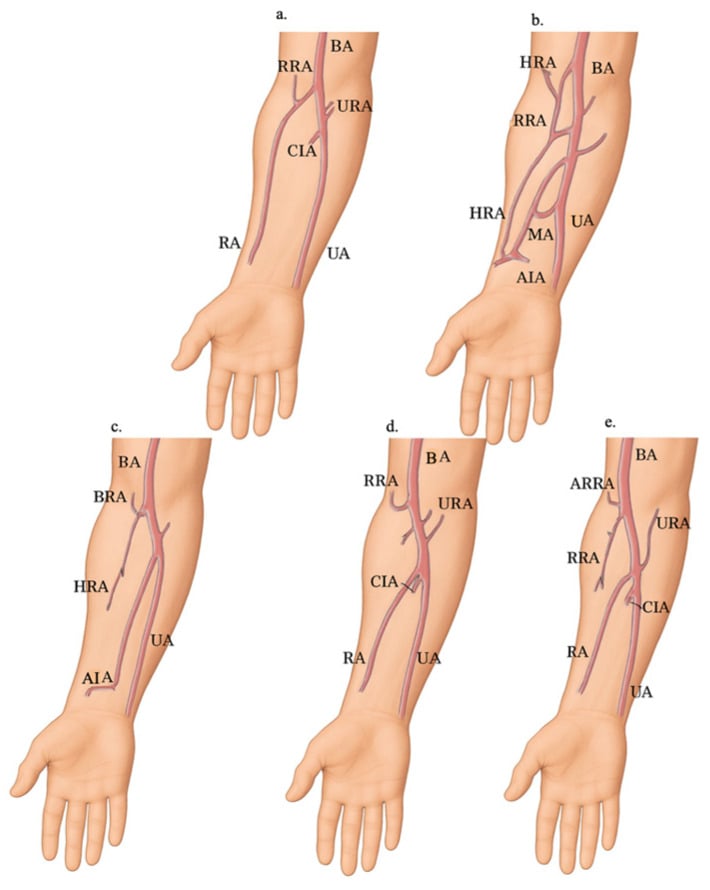 Classification schematic of radial artery origin and course variants in the upper limb, including high-origin and aberrant types