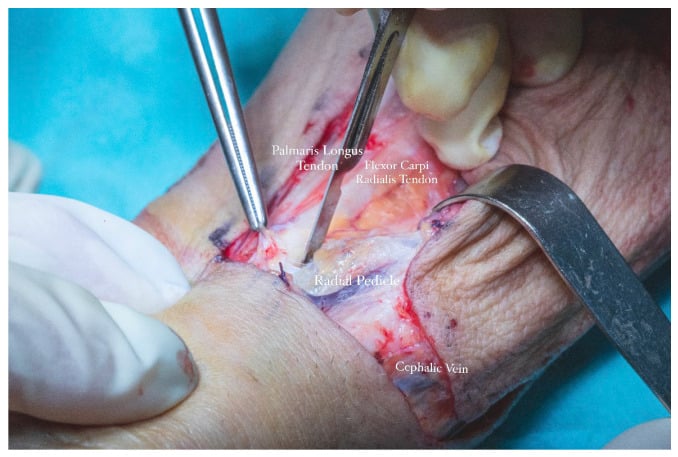 Operative radial forearm free flap dissection showing palmaris longus, flexor carpi radialis, radial vascular pedicle and cephalic vein