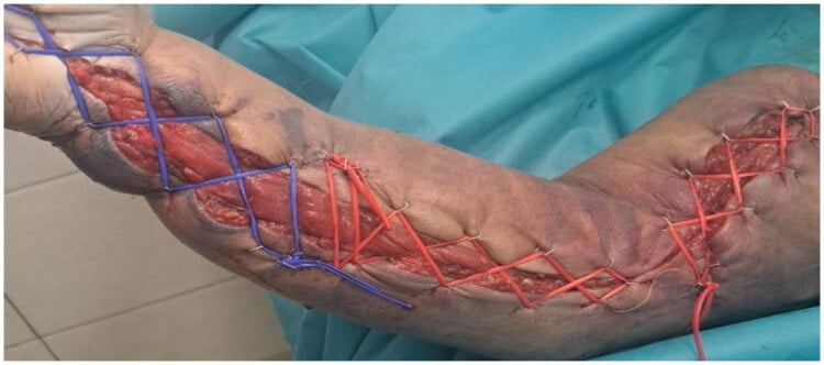 Forearm fasciotomy wounds undergoing progressive approximation with vessel-loop shoelace closure