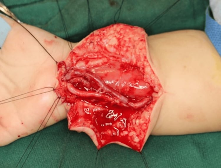 Intraoperative distal forearm view after ulnar artery reconstruction using an interposition vein graft