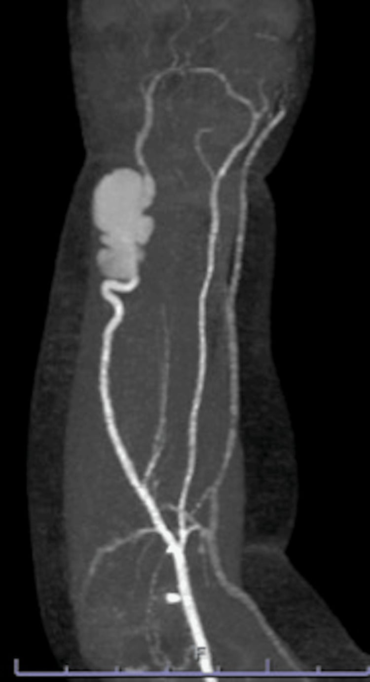 Contrast-enhanced CT angiogram of the forearm showing a focal ulnar artery pseudoaneurysm with a patent radial artery