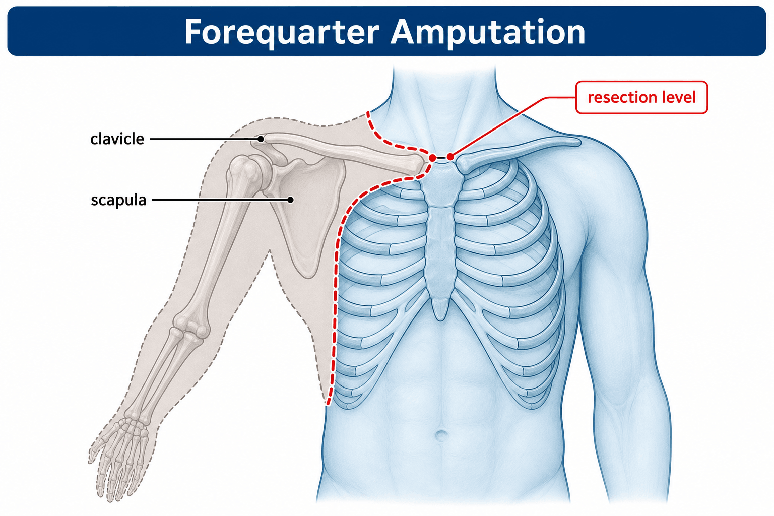 forequarter amputation resection level
