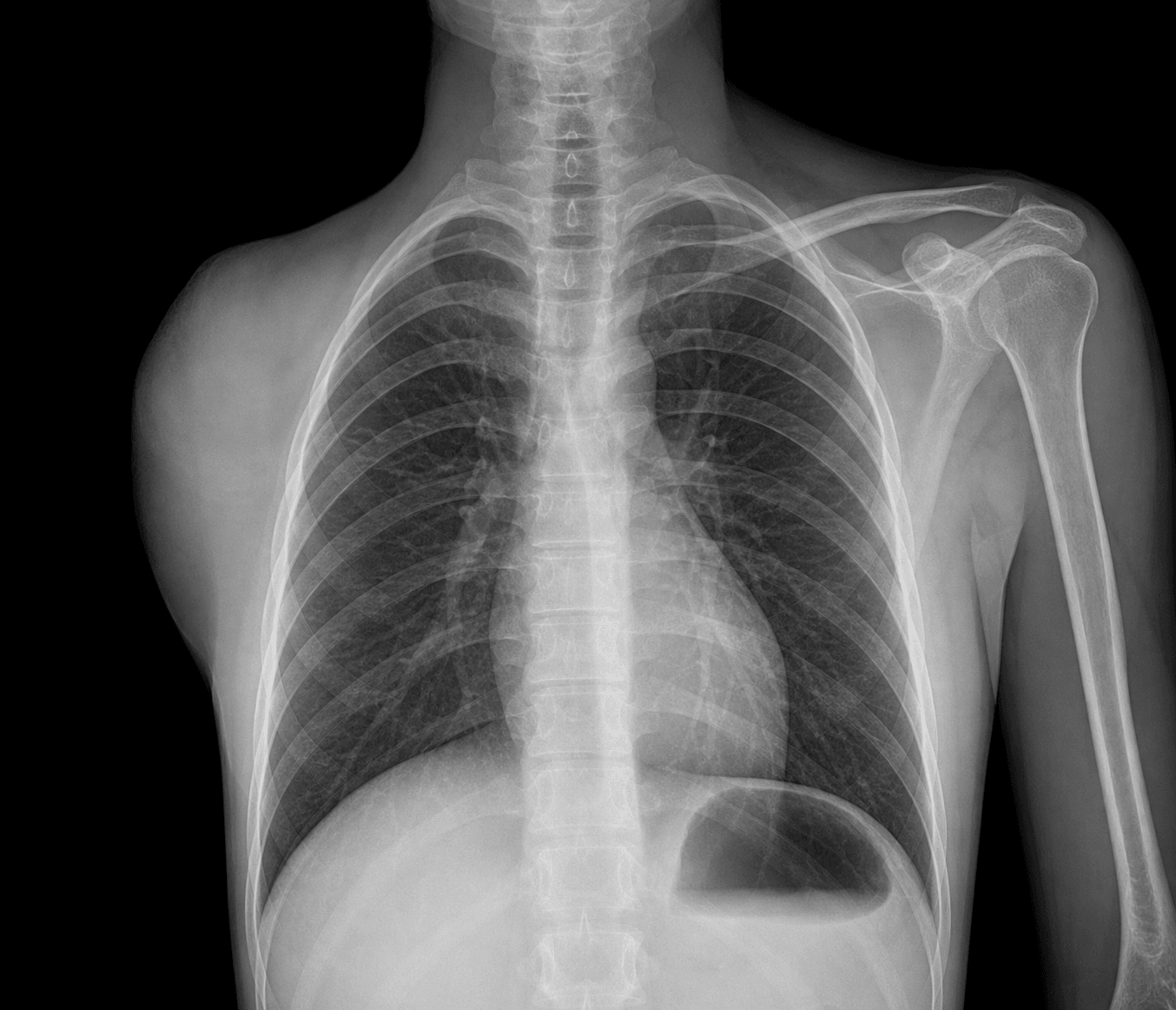 AP chest radiograph after a forequarter amputation showing complete absence of one shoulder girdle and upper limb.