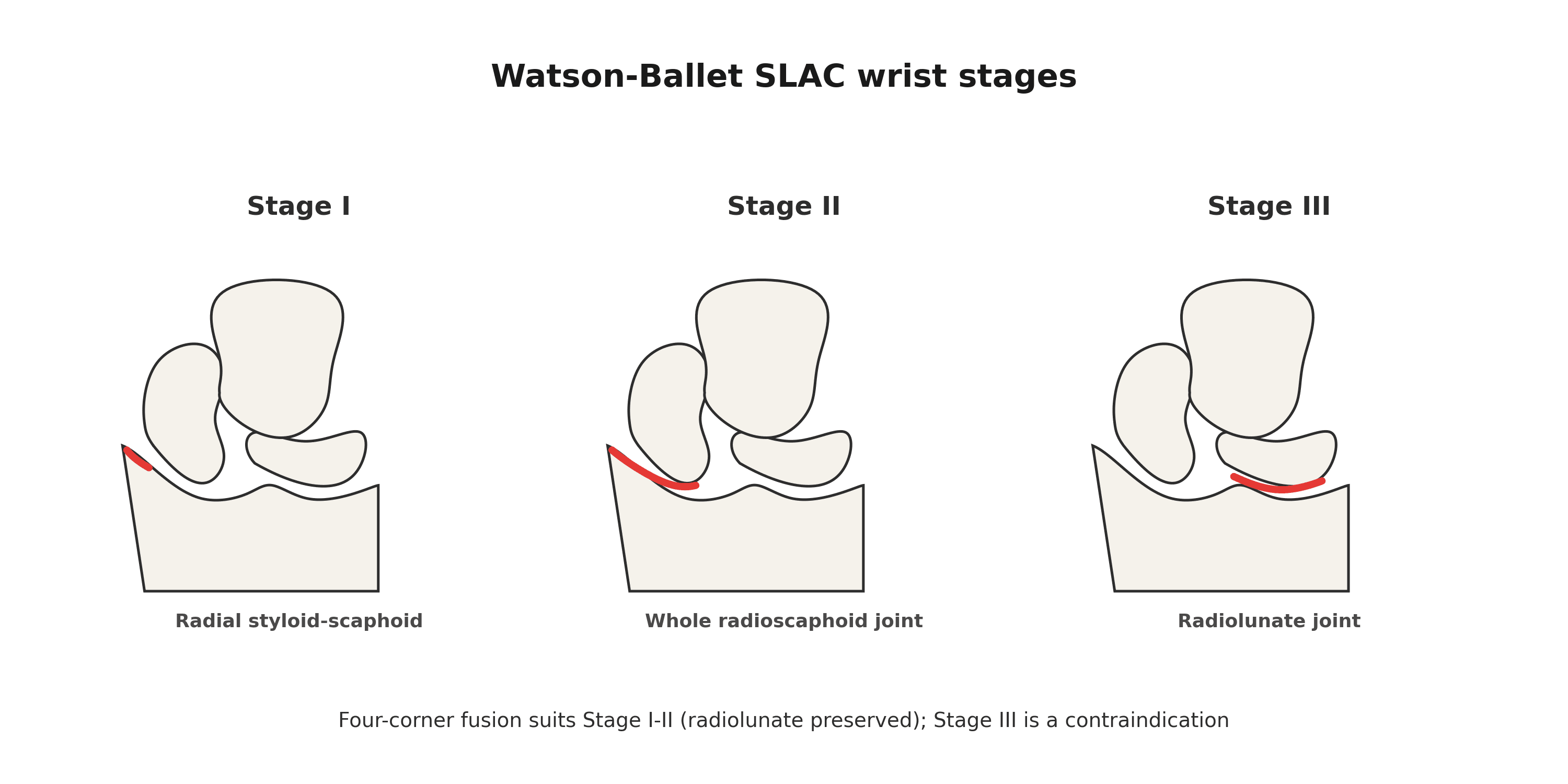 Diagram of the three Watson-Ballet SLAC wrist stages showing arthritis progressing from the radial styloid-scaphoid joint to the radioscaphoid joint to the radiolunate joint
