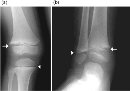 Two X-rays, knee and ankle of a child, with arrows marking irregular frayed and flared metaphyses of the distal femur and proximal tibia.