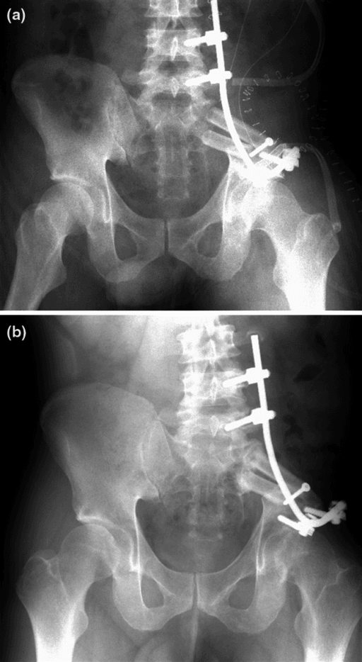 Radiographs of pelvis reconstructed with a double-barrel fibular graft and a posterior rod, showing union.