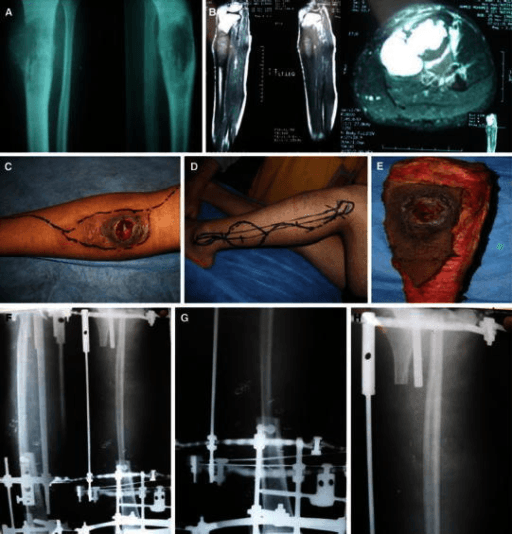 Multi-panel figure with tibial radiograph, MRI and intraoperative photographs of planned incisions.