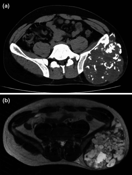 Axial CT and T2-weighted axial MRI of a lobulated calcified tumour of the left ilium.
