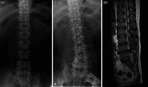 Paired pelvic radiographs years apart showing progressive scoliosis, with sagittal T2-weighted lumbar MRI.