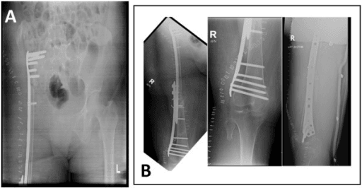Anteroposterior pelvic and femoral radiographs showing a fibular graft fixed with a locking compression plate.