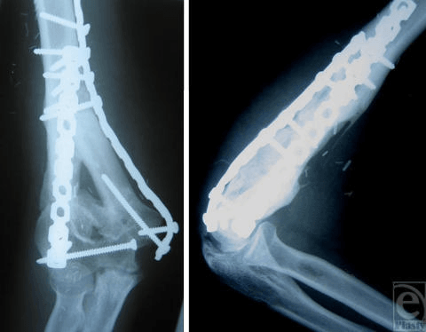 Anteroposterior and lateral elbow radiographs showing an incorporated fibular graft with healed fracture.